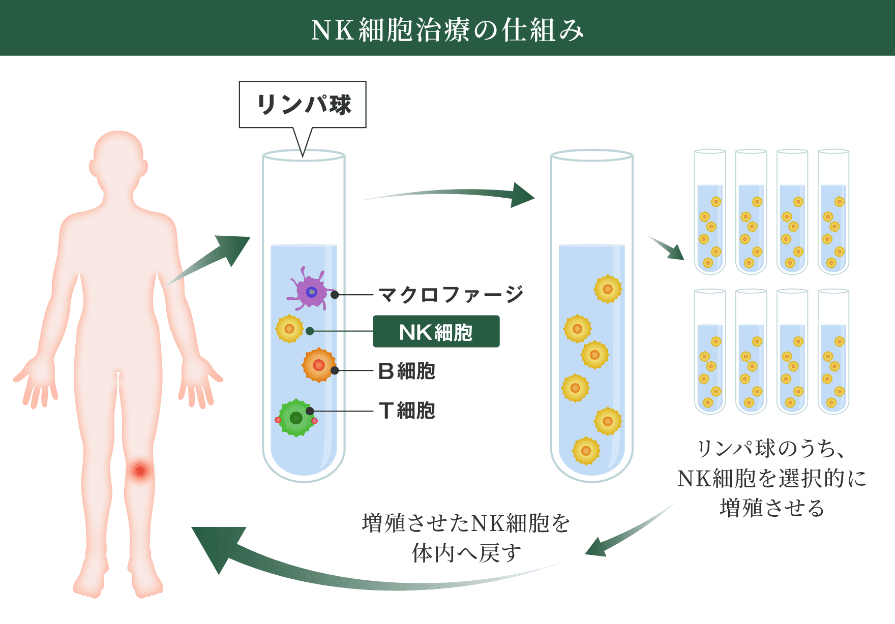 NK細胞治療の仕組み