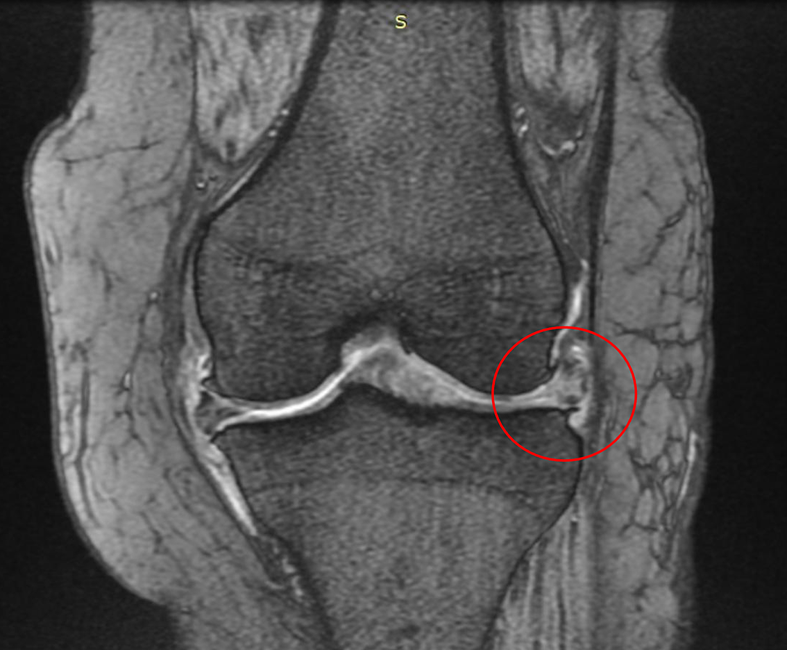 画像所見(MRI)