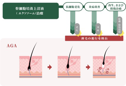 エクソソーム治療