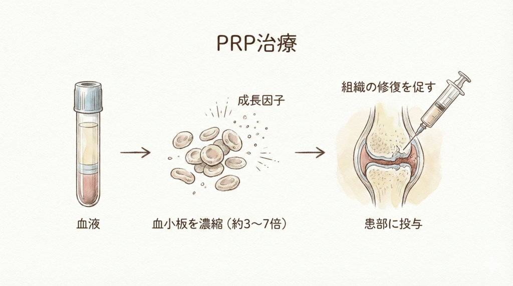 PRP治療 — 自分の血液で膝を治す手軽な選択肢