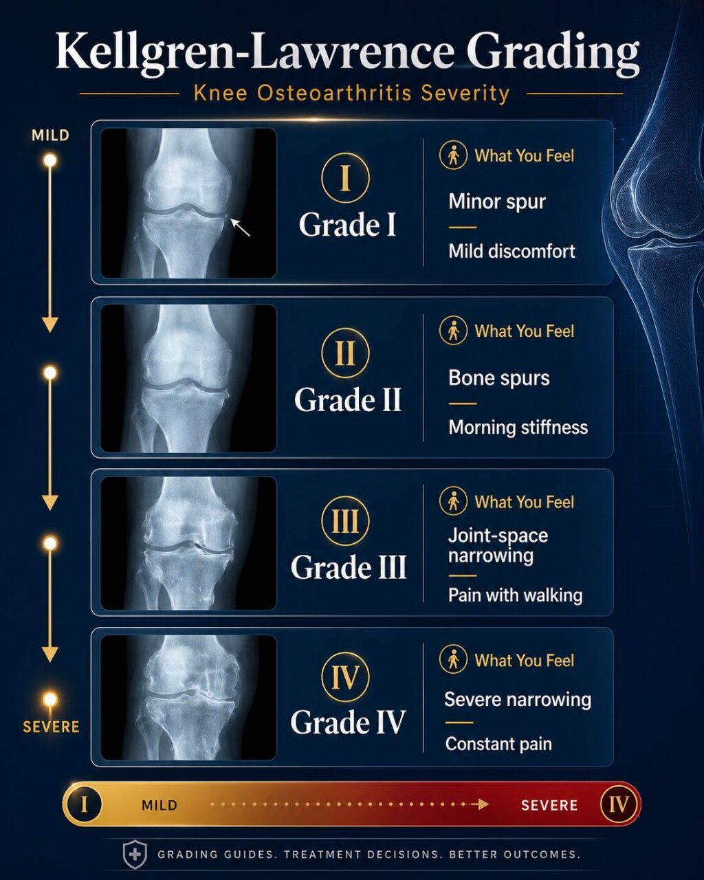 The Kellgren-Lawrence Grading System for knee Osteoarthritis.