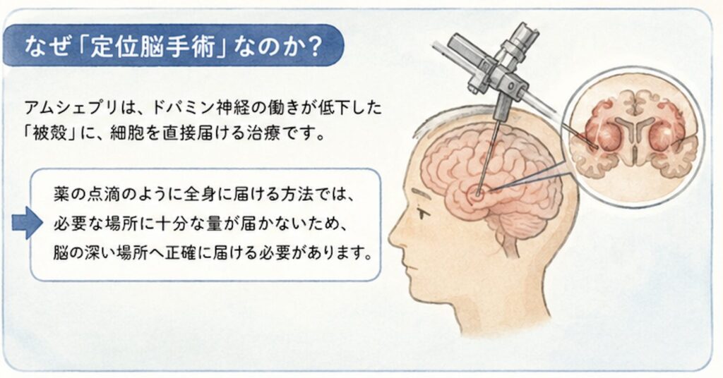 定位脳手術は、脳深部刺激療法（DBS）でも使われている脳神経外科の標準的な手技ですが、点滴投与や髄腔内投与と比べると侵襲性は明らかに高い処置です。全身麻酔リスク、出血、感染、移植細胞の腫瘍化リスク、ジスキネジアの増悪などはゼロにはできません。