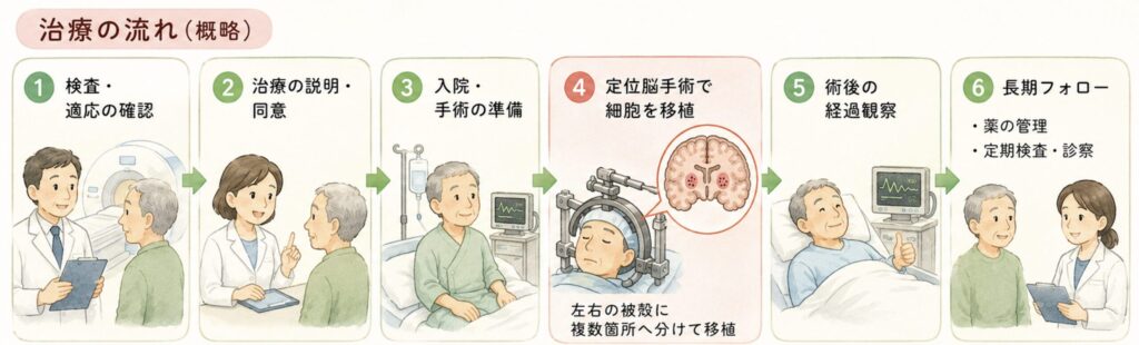 治療の流れ（概略）

適応評価：神経内科・脳神経外科による精密検査、MRI、レボドパ反応性評価

治療同意・施設要件確認：条件・期限付承認下のため、最適使用推進ガイドライン対象施設での実施

入院：手術前検査、麻酔評価

定位脳手術：全身麻酔下で頭蓋骨に小孔を作成→定位フレームによるガイド下に、ドパミン神経前駆細胞を左右両側の被殻に複数箇所、分割移植

術後管理：入院での経過観察（出血・感染・移植細胞の異常増殖モニタリング）

長期フォロー：免疫抑制薬の投与期間管理、定期的なMRI・PET・運動症状評価